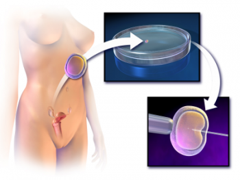 IVF