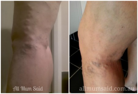 pregnancy veins